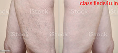 How to get rid of spider veins