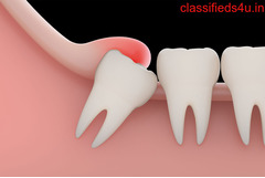 Wisdom Tooth Removal Dentist