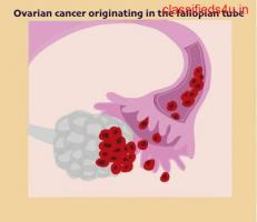Ovarian Cancer Treatment in Ahmedabad