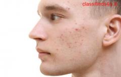 Get the Best Acne Treatment in Ludhiana at Bliss Laser Skin Clinic
