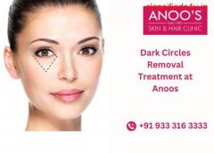 Advanced Dark circles removal treatment at Anoos